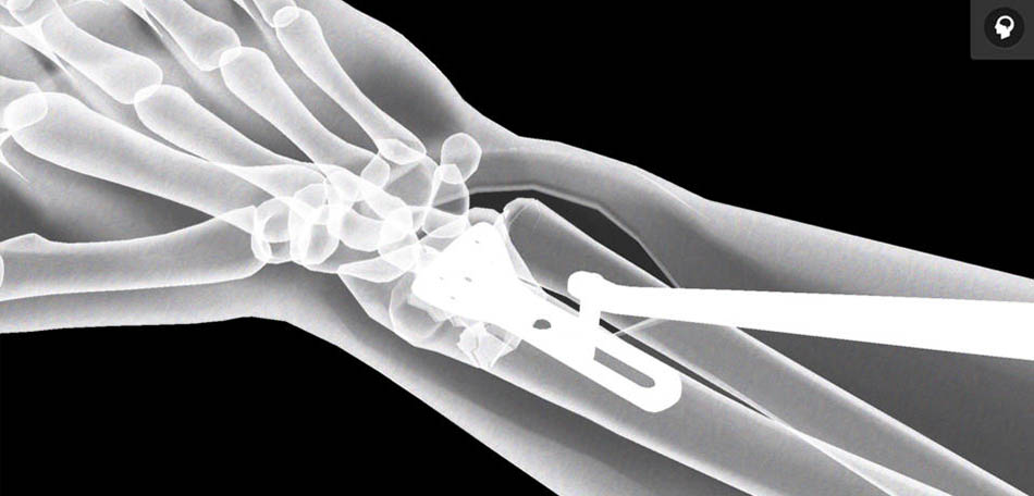 Wrist repair - App ortopedia