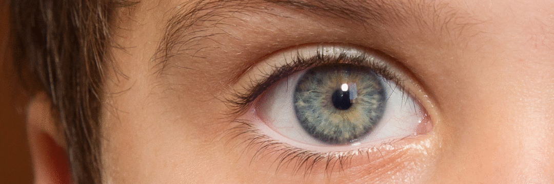 Retinoblastoma: oftalmologistas alertam sobre a saúde ocular das crianças