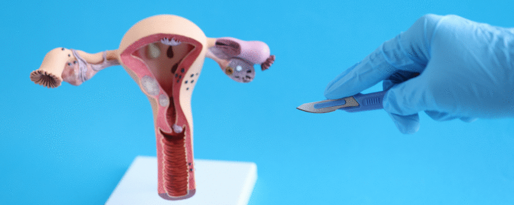 Cientistas desenvolvem nanopartículas capazes de tratar a endometriose