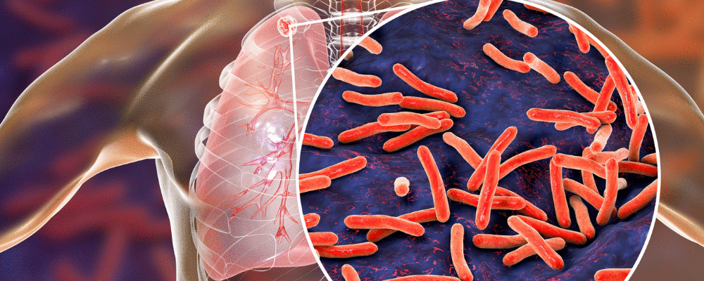 Número de mortos pela tuberculose volta a crescer pela primeira vez em mais de uma década