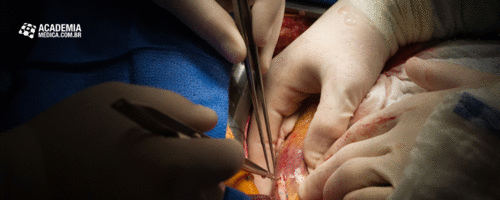 Qual a expectativa de vida após a substituição cirúrgica da válvula aórtica?